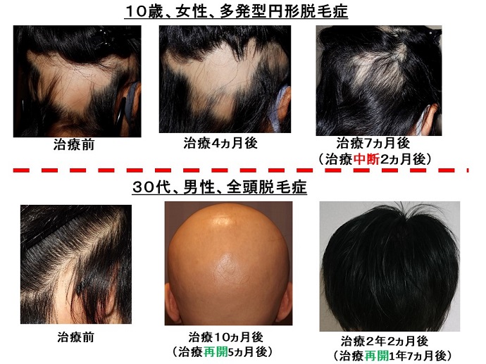円形脱毛症　病院